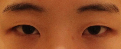 韩国普拉美斯整形外科眼综合对比