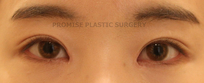 韩国普拉美斯整形外科眼部整形图片