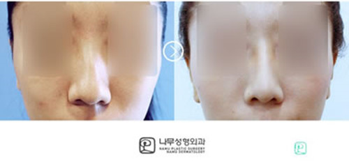 韩国首尔有名的鼻整形医院名字汇总：nano、那木trend在其列