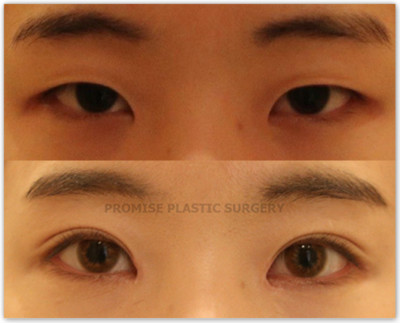 韩国普拉美斯医院双眼皮手术对比