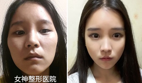 韩国女神面部填充+轮廓整形真人案例