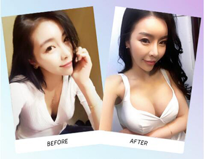 韩国丽延长整形外科胸部整形前后对比照片