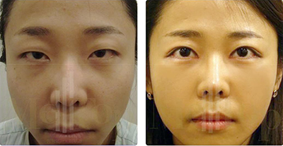 韩国MeTop整形外科双眼皮手术对比日记
