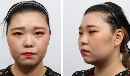韩国HB整形眼、轮廓手术案例图
