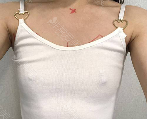 韩国假体隆胸手术案例图