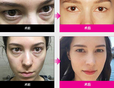 韩国LaPrin来福琳整形外科黑眼圈治疗照片