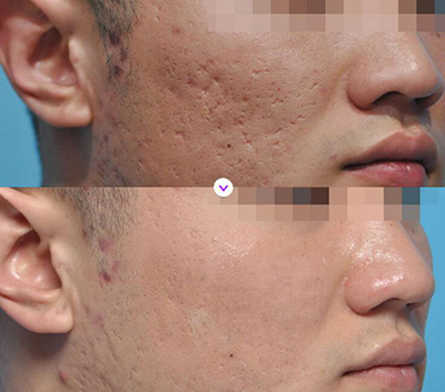 韩国LaPrin来福琳整形外科疤痕治疗前后对比照片