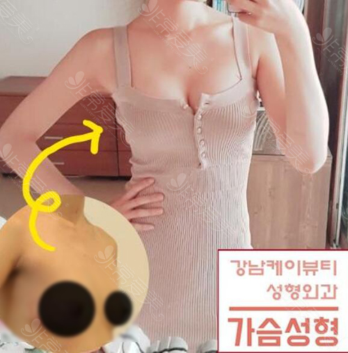 韩国K-beauty整形医院胸部整形案例图