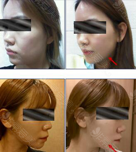 韩国K-beauty整形医院面部提升手术前后对比照片