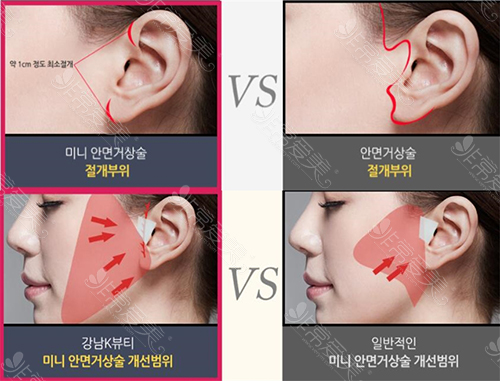 韩国K-beauty整形医院面部提升手术切口示意图