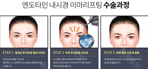 韩国K-beauty安多泰额头提升卡通示意图