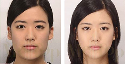 韩国MeTop整形外科面部轮廓整形手术对比案例