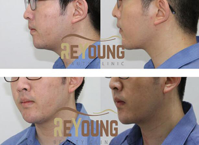 韩国丽颖整形外科面部吸脂前后对比照片