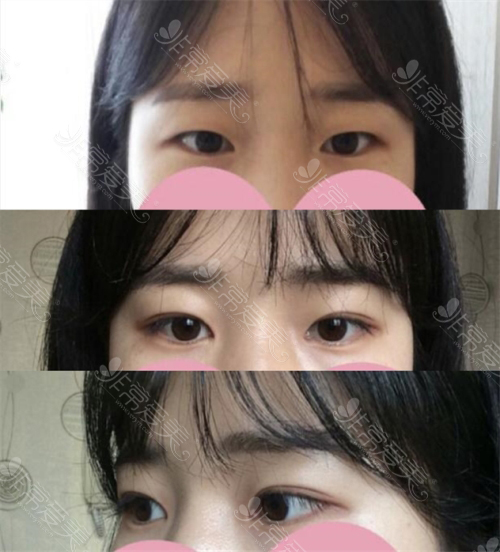韩国TJ整形外科眼部整形前后对比照片