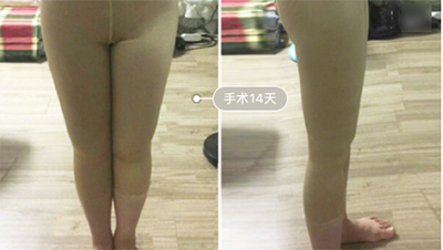 韩国hb整形外科腿部手术案例