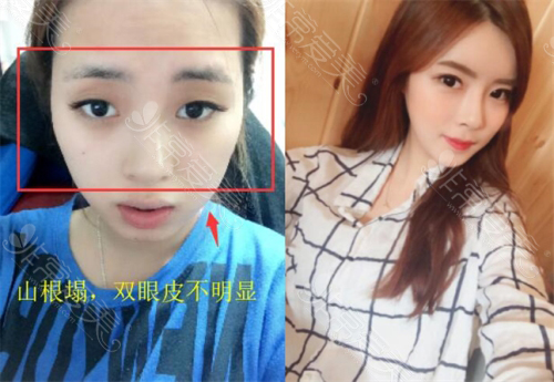 韩国ID整形医院眼鼻整形前后对比照片