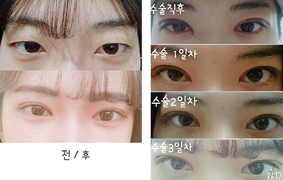 韩国纯真整形外科眼部手术照片