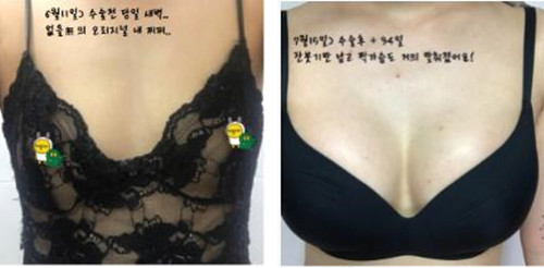 韩国朴真奭PJS整形隆胸图