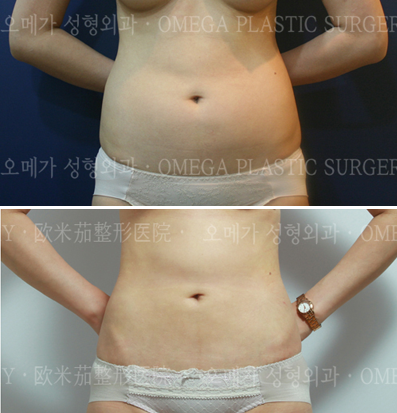 韩国omega整形外科腰腹吸脂日记