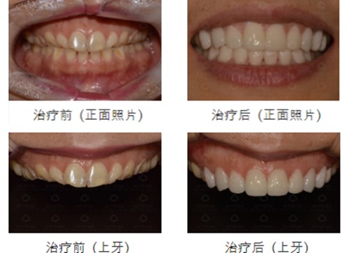 韩国安特丽牙齿整形效果前后对比图