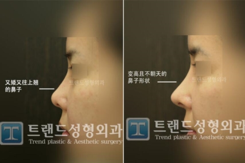 韩国trend整形外科鼻部手术案例