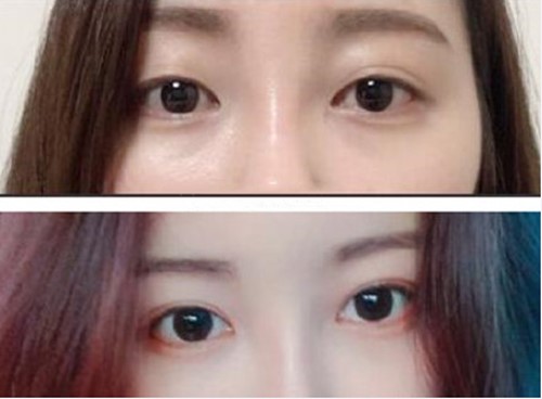 韩国(Crapas)双眼皮手术真人案例