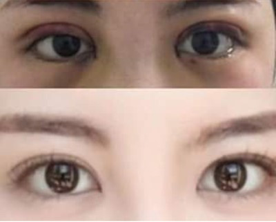 韩国(Crapas)双眼皮手术真人案例图