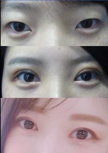 韩国(Crapas)双眼皮手术前后对比图