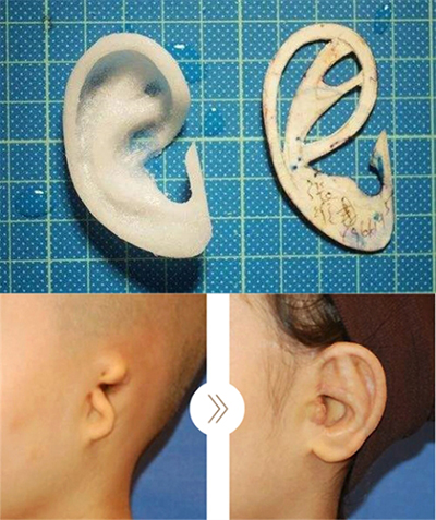 韩国普罗菲耳整形外科缺失耳整形照片