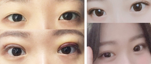韩国crapas双眼皮手术真人日记
