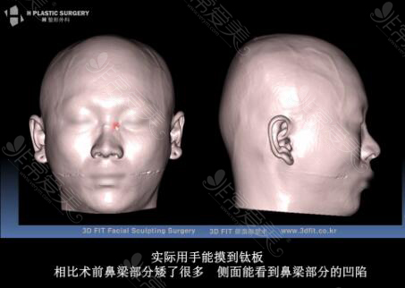 韩国白汀桓鼻子修复3D影像图