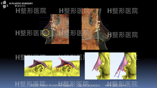 韩国白汀桓鼻子修复术前假想设计图