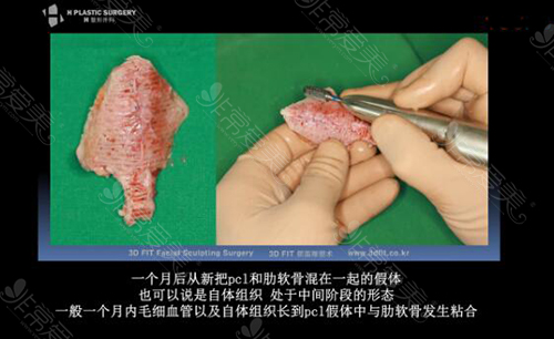 韩国H整形白汀桓鼻修复材料图片