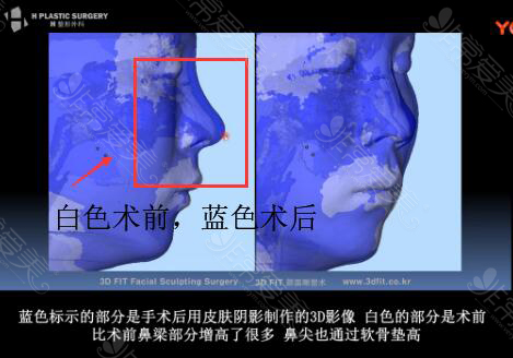韩国H整形白汀桓鼻修复前后3D影像对比图