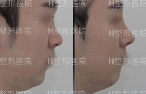韩国H整形白汀桓鼻修复前后对比照片
