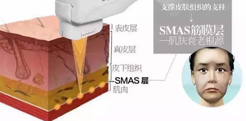 SMAS筋膜层示意图