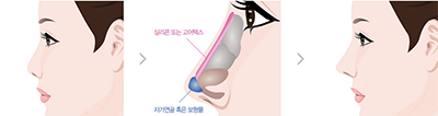 硅胶隆鼻手术解析