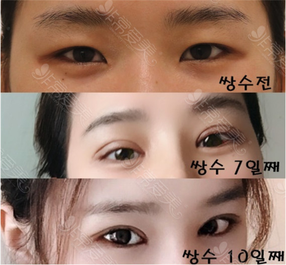 韩国纯真整形中国妹子的眼整形恢复生图