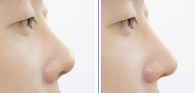 韩国ALLURA整形外科鼻部整形前后对比照片