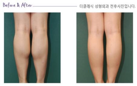 韩国德克莱斯整形外科小腿整形术照片