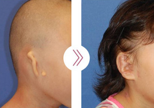 韩国profile小耳畸形手术图片