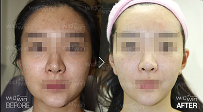 韩国widwin面部吸脂案例对比