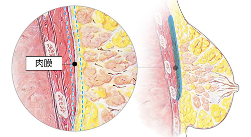 韩国麦恩整形外科隆胸手术优势分析