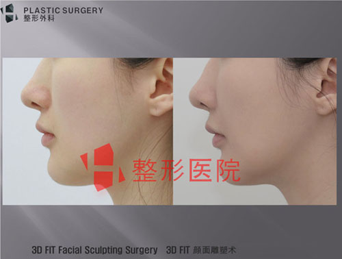 H整形外科鼻基底整形案例