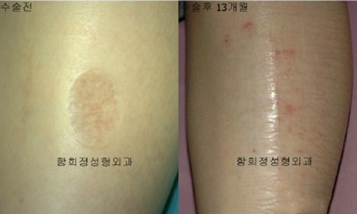 韩国Dr.ham's瘢痕治疗前后对比图