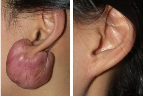 韩国安成烈耳部瘢痕治疗对比图
