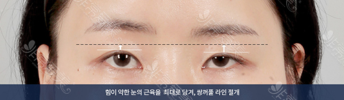韩国ID整形外科大小眼整形照片
