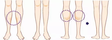 小腿神经阻断卡通图 小腿神经阻断卡通图