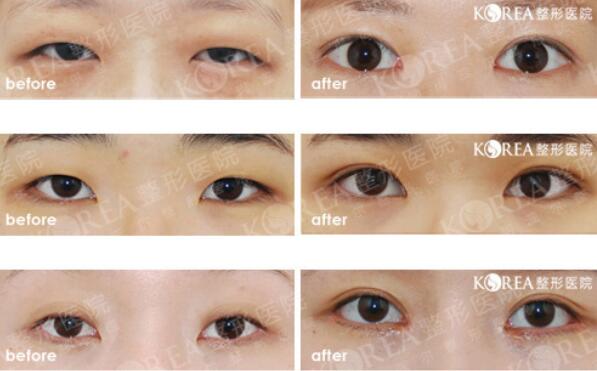 韩国KOREA整形外科眼部整形照片