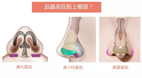 韩国鼻基底怎么垫？填充术前术后对比照片什么样？